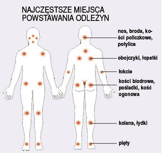 Najczęstsze miejsca powstania odleżyn